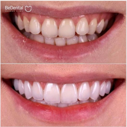 Một chút tinh chỉnh đường lợi kết hợp dán sứ Veneer được bác sĩ tại Bedental hoàn thiện cho chị khách hàng chiều nay