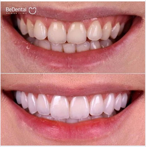 Một chút tinh chỉnh đường lợi kết hợp dán sứ Veneer được bác sĩ tại Bedental hoàn thiện cho chị khách hàng chiều nay