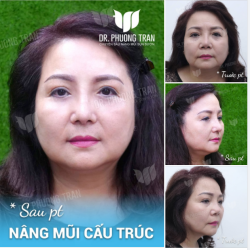 MỘT ĐIỂN HÌNH MŨI CO RÚT, LỆCH SỐNG