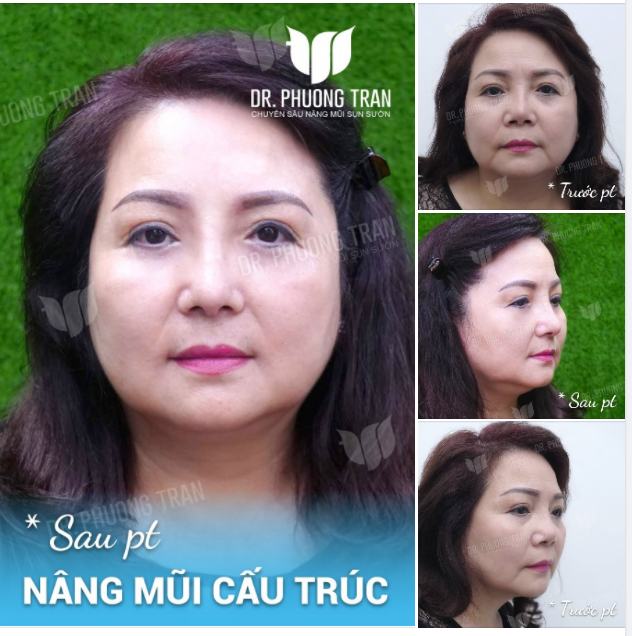 MỘT ĐIỂN HÌNH MŨI CO RÚT, LỆCH SỐNG