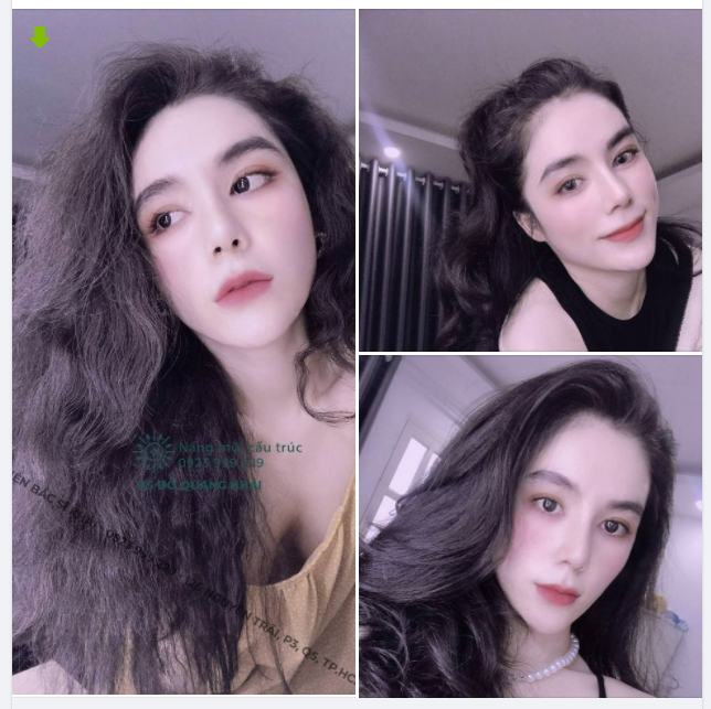 MŨI CẤU TRÚC XỬ LÝ FILLER + MỞ GÓC MẮT TRONG - NGOÀI SAU 1 THÁNG!