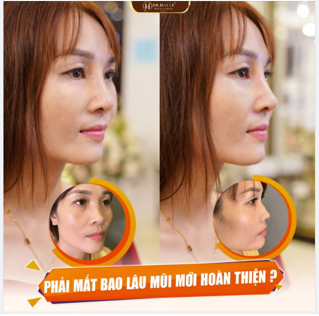 Mũi Demi Tech 6D sau 10 ngày thực hiện - Xứng đáng là dáng mũi "Siêu phẩm" tại Dr.Hải Lê.!!