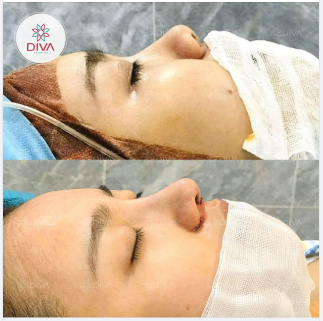 MŨI HẾCH, DA ĐẦU MŨI MỎNG VÀ KẾT QUẢ SAU NÂNG MŨI SLINE SỤN TỰ THÂN