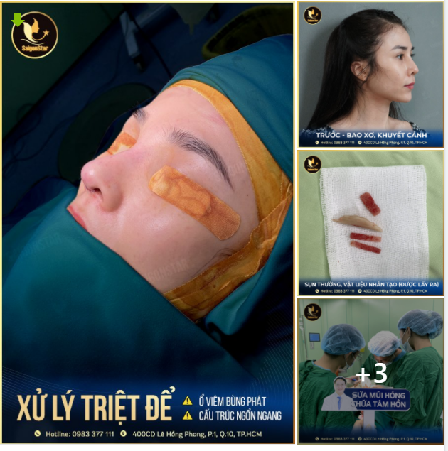 ​​​​​​​ MŨI HỎNG HÓA MŨI XINH