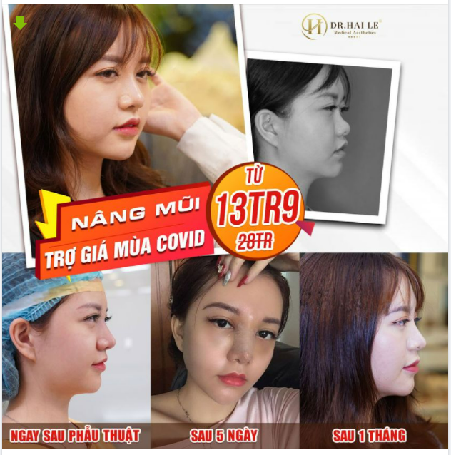 Mũi thấp, tẹt, hếch...và vô vàn các khuyết điểm khác ở dáng mũi. CHUYỆN NHỎ