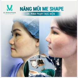 MŨI THẤP TẸT "HÓA" ĐẸP KHÔNG GÓC CHẾT NÂNG MŨI ME SHAPE - BẤT BẠI TRƯỚC MỌI KHUYẾT ĐIỂM CỦA MŨI