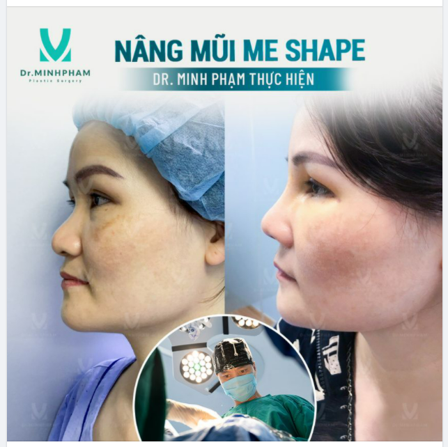 MŨI THẤP TẸT "HÓA" ĐẸP KHÔNG GÓC CHẾT NÂNG MŨI ME SHAPE - BẤT BẠI TRƯỚC MỌI KHUYẾT ĐIỂM CỦA MŨI