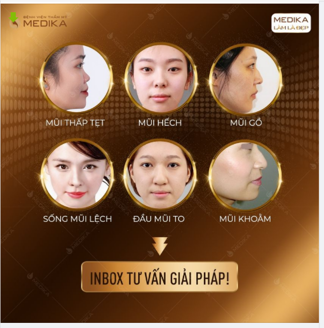 Mũi thấp tẹt - Mũi hếch - Mũi gồ Sống mũi lệch - Đầu mũi to - Mũi khoằm️