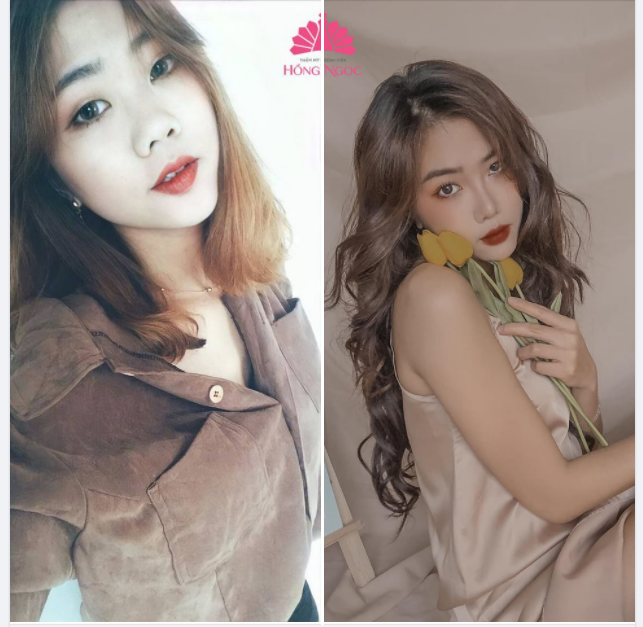 MŨI THẤP TẸT TO BÈ - CHỌN NÂNG MŨI WISH LINE