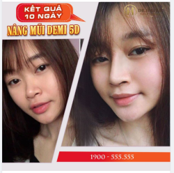 Mũi vào form như ý sau 10 ngày - BẠN CÓ TIN?