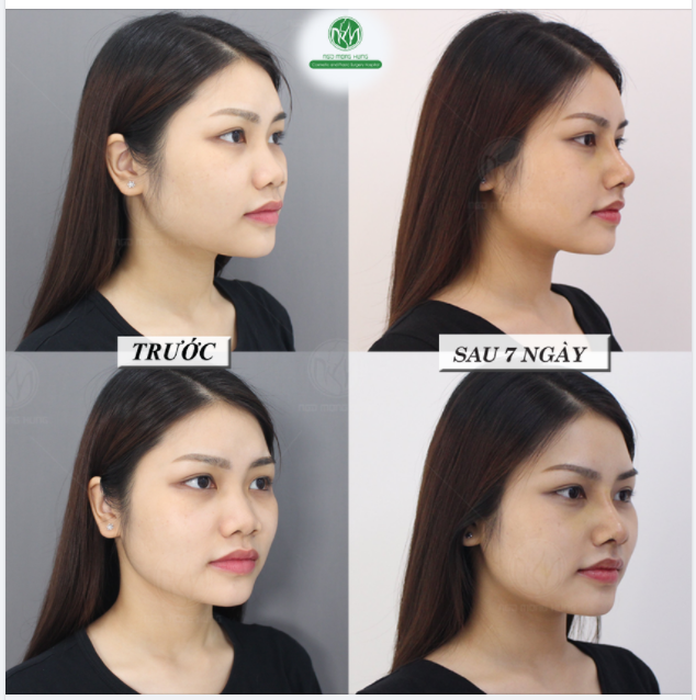 MŨI XINH 7 NGÀY TUỔI - XÓA BỎ MỌI KHUYẾT ĐIỂM