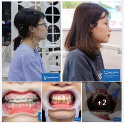 Năm 2019 khi lần đầu bạn Hoài đến với Nha khoa vẫn còn ngượng ngùng với hàm trên bị hô, hàm dưới khấp khểnh. Sau 10 tháng kiên trì và cố gắng, cùng chúc mừng cho sự thay đổi tích cực của bạn ấy nhé.