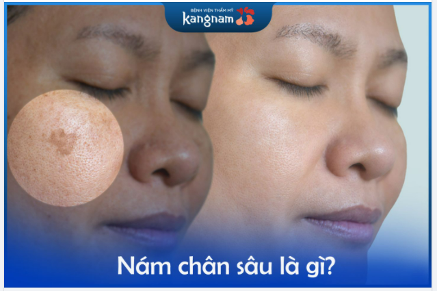 NÁM CHÂN SÂU là gì?