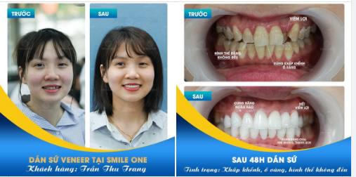 NÂNG CẤP NỤ CƯỜI HOÀN HẢO CHO KHÁCH HÀNG