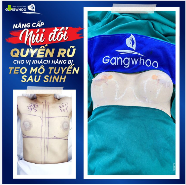 NÂNG CẤP "NÚI ĐÔI" QUYẾN RŨ CHO CHỊ KHÁCH HÀNG BỊ TEO MÔ TUYẾN SAU SINH