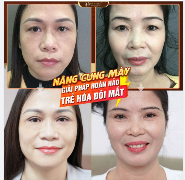 NÂNG CUNG MÀY - GIẢI PHÁP HOÀN HẢO CHO ĐÔI MẮT TƯƠI TRẺ.!