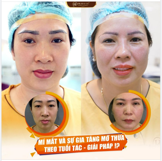 Nâng cung mày tại Dr Hải Lê