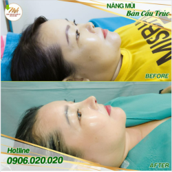Nâng Mũi Bán Cấu Trúc 9Tr Bs Mã Hiệp không bao giờ làm bạn thất vọng