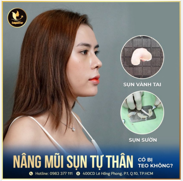 NÂNG MŨI BẰNG SỤN TỰ THÂN CÓ BỊ TEO KHÔNG?