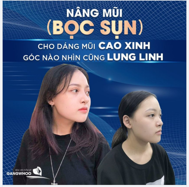 NÂNG MŨI BỌC SỤN - CHO DÁNG MŨI CAO XINH, LUNG LINH TRONG TỪNG GÓC NHÌN