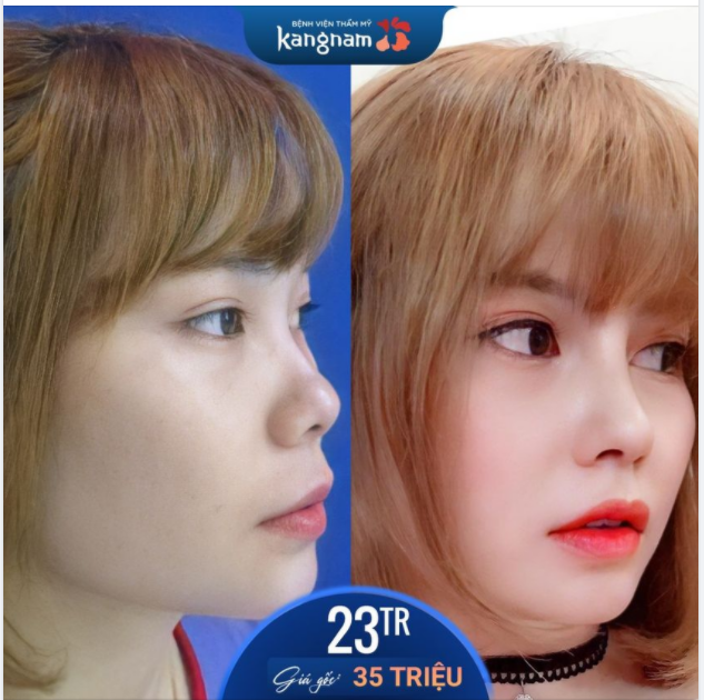 NÂNG MŨI cao sang chuẩn hotgirl chỉ với 23 Triệu