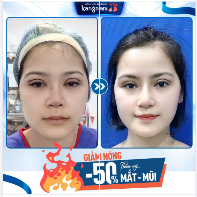 NÂNG MŨI CẮT MÍ - COMBO LỘT XÁC CHUẨN HOTGIRL