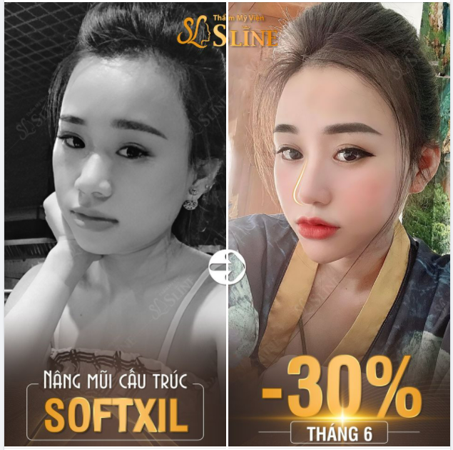 NÂNG MŨI CẤU TRÚC SOFTXiL