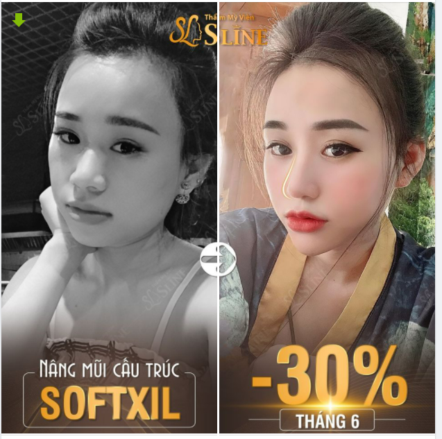 NÂNG MŨI CẤU TRÚC SOFTXIL