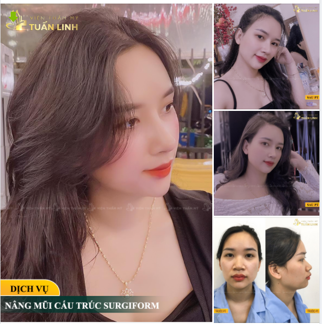 NÂNG MŨI CẤU TRÚC SỤN SURGIFORM - ĐỈNH CAO TRONG TẠO HÌNH MŨI.