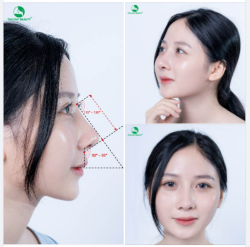 NÂNG MŨI CHUẨN Y KHOA - ĐẸP HÀI HOÀ MỌI GÓC ĐỘ