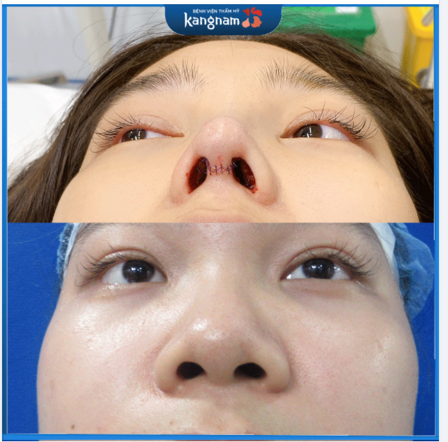 NÂNG MŨI "đẳng cấp" với tạo hình lỗ mũi chuẩn hình hạt chanh