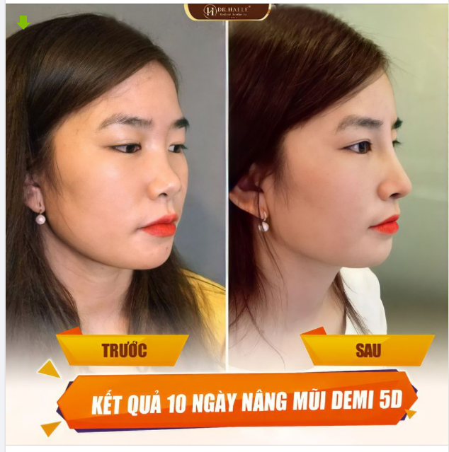 Nâng mũi Demi 5D - Dáng mũi được yêu thích tại Dr.Hải Lê.!