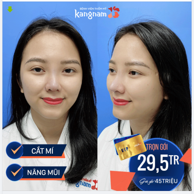 Nâng mũi kết hợp Cắt mí - Giá chưa bao giờ ĐẸP như hôm nay