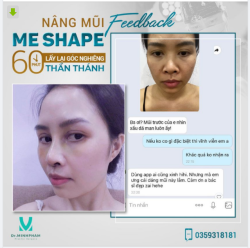 NÂNG MŨI ME SHAPE BYE BYE MŨI TẸT – ĐẸP NGAY SAU LÀM