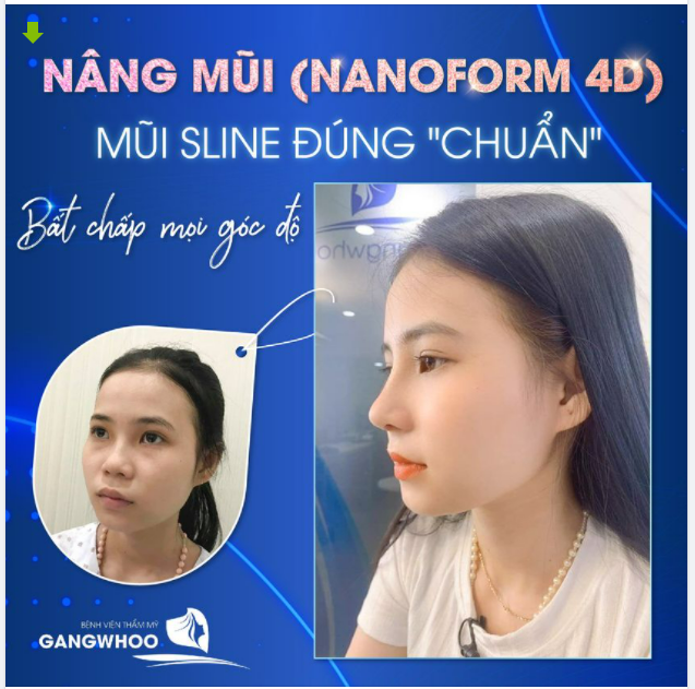 NÂNG MŨI (NANOFORM 4D) MŨI SLINE ĐÚNG CHUẨN, BẤT CHẤP MỌI GÓC ĐỘ