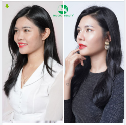 Nâng mũi sạch khuẩn - Bí quyết sở hữu "góc nghiêng thần thánh" chỉ sau khoảng 15'