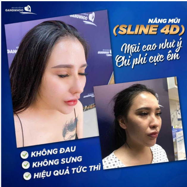 NÂNG MŨI (SLINE 4D) - MŨI CAO NHƯ Ý, CHI PHÍ CỰC ÊM