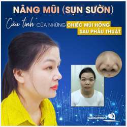 NÂNG MŨI (SỤN SƯỜN) - CỨU TINH CỦA NHỮNG CHIẾC MŨI HỎNG SAU PHẪU THUẬT