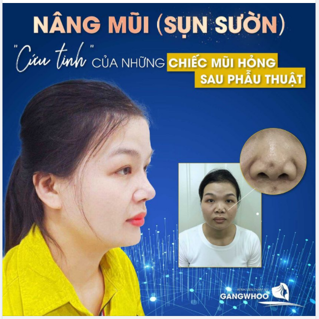 NÂNG MŨI (SỤN SƯỜN) - CỨU TINH CỦA NHỮNG CHIẾC MŨI HỎNG SAU PHẪU THUẬT