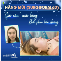 NÂNG MŨI (SURGIFORM 6D) - GIẢI CỨU MŨI HỎNG, KHẮC PHỤC BIẾN CHỨNG