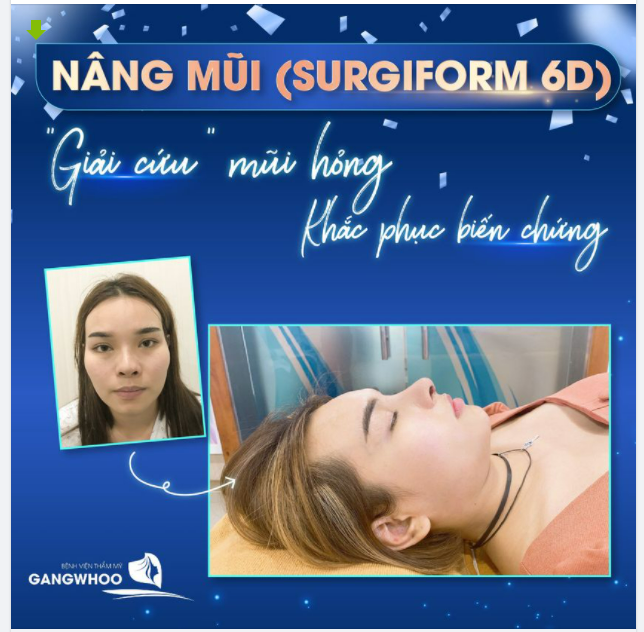 NÂNG MŨI (SURGIFORM 6D) - GIẢI CỨU MŨI HỎNG, KHẮC PHỤC BIẾN CHỨNG