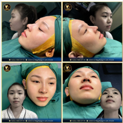 NÂNG MŨI SURGIFORM - XINH ĐẸP MỌI GÓC NHÌN