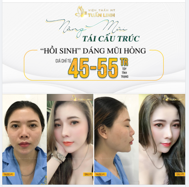 NÂNG MŨI TÁI CẤU TRÚC (DÀNH CHO MŨI SỬA LẠI) GIÁ CHỈ TỪ 45- 55 tr (TÙY TÌNH TRẠNG).