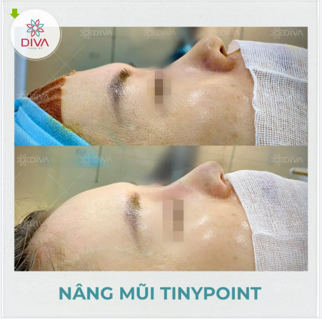 NÂNG MŨI TINY POINT: MŨI ĐẸP, MŨI XỊN SAU 15 PHÚT