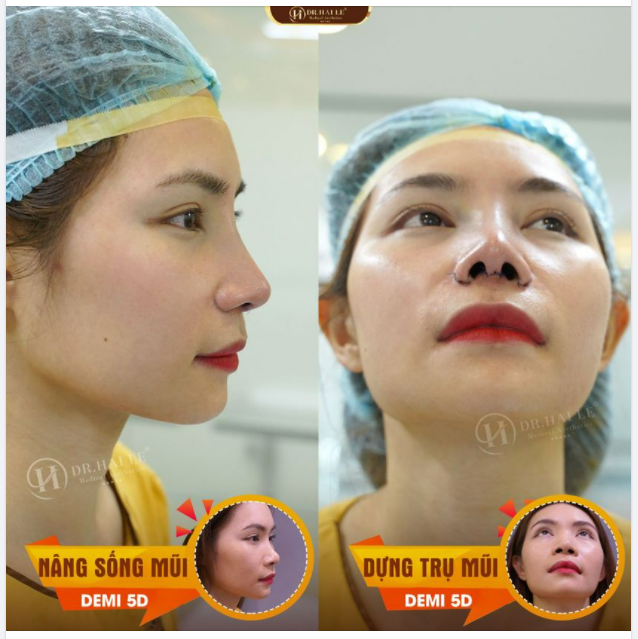 Nâng mũi Trợ giá Covid - Dr.Hải Lê tặng 20 suất chi phí tiết kiệm - chỉ từ 13tr9 đến 45tr9