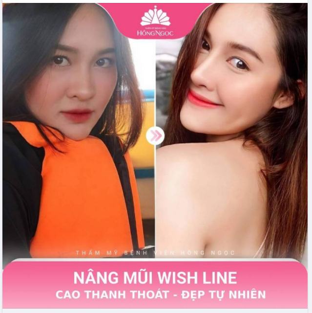 NÂNG MŨI WISH LINE - CHIẾM TRỌN SPOTLIGHT