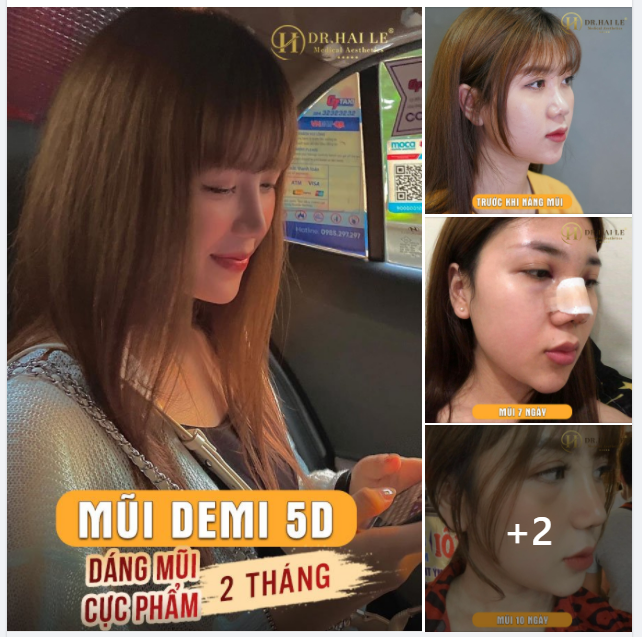 Nâng mũi xong cứ tưởng không đẹp......Ai ngờ...