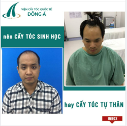 NÊN CẤY TÓC SINH HỌC HAY TỰ THÂN