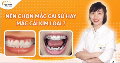 NÊN CHỌN NIỀNG RĂNG MẮC CÀI KIM LOẠI HAY MẮC CÀI SỨ