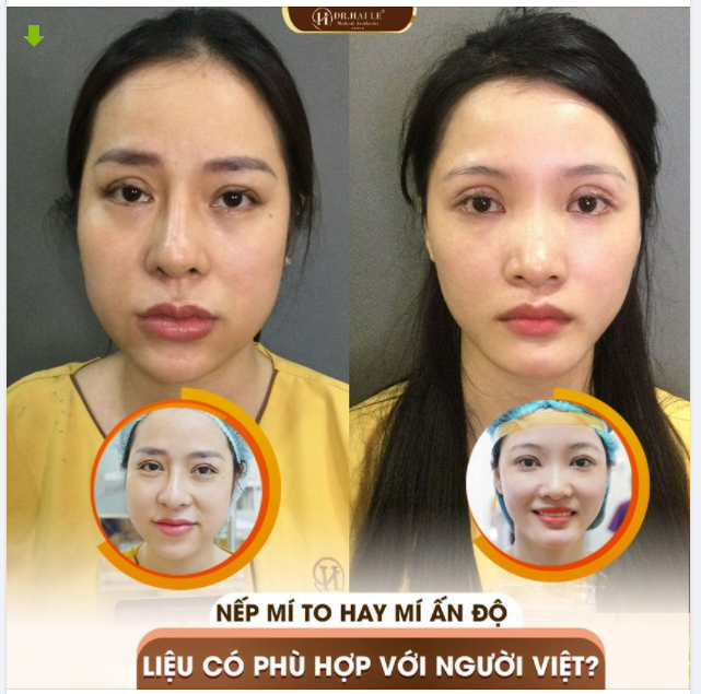 Nếp mí to hay mí Ấn Độ liệu có phù hợp với người Việt